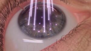 cirugia laser