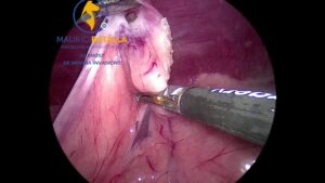 esterilizacion laparoscopia