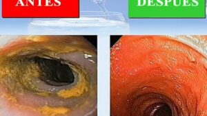 hidroterapia colon