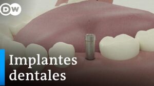implantes dentales