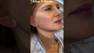 lifting facial