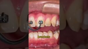 los brackets