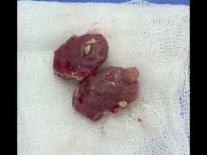 operacion amigdalas