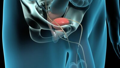 operacion prostata