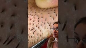 pelos encarnados