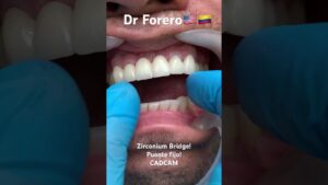 puentes zirconio