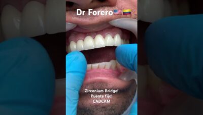 puentes zirconio