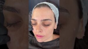 relleno ojeras